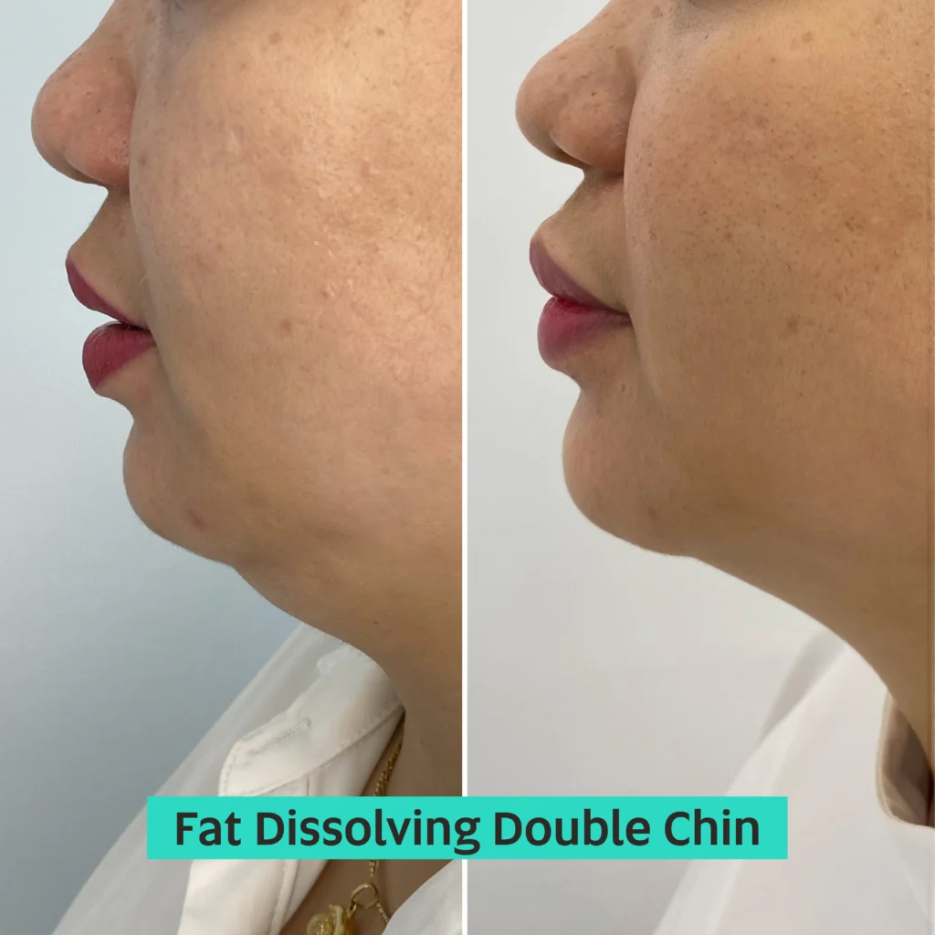 Fat Dissolving Double Chin